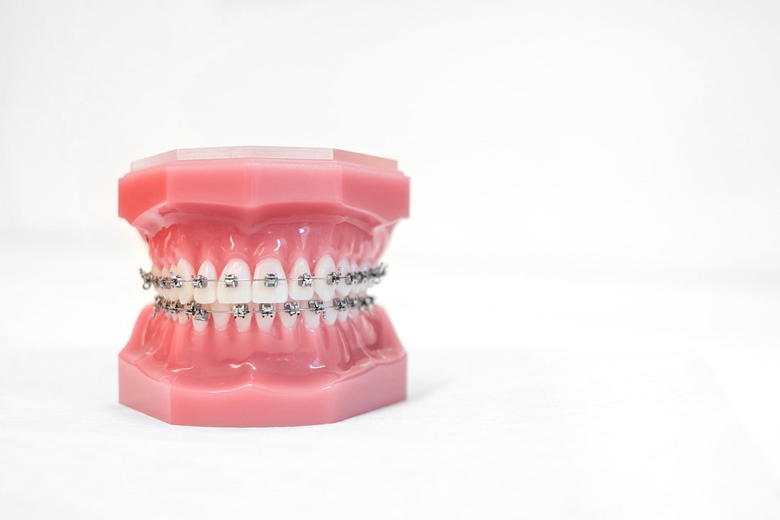 Why Should I Choose Braces
